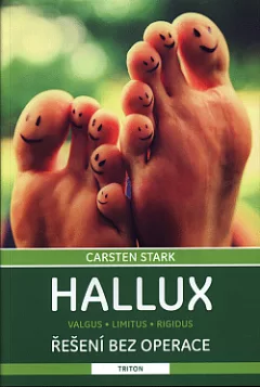 Hallux – řešení bez operace