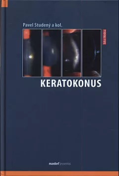 Keratokonus